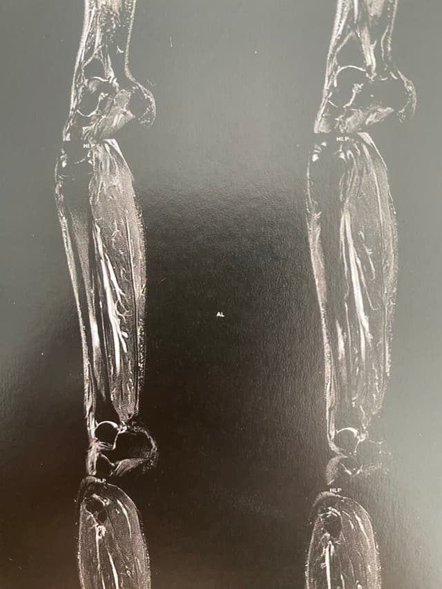 IRM du tibia montrant la fracture de fatigue